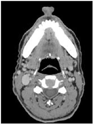 A Clinical Study Investigating Whether the Tongue-Out Position Improves the Quality of the Anatomical Appearance of the Pharynx on CT Imaging